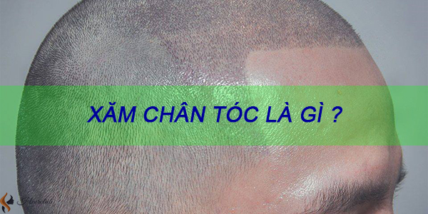 Xăm chân tóc cho người hói  Hanoi