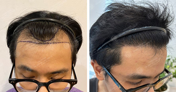 ThS.BS Lê Quang Vương cấy tóc có hiệu quả không?