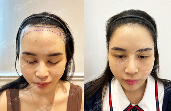 ThS.BS Lê Quang Vương cấy tóc có hiệu quả không?
