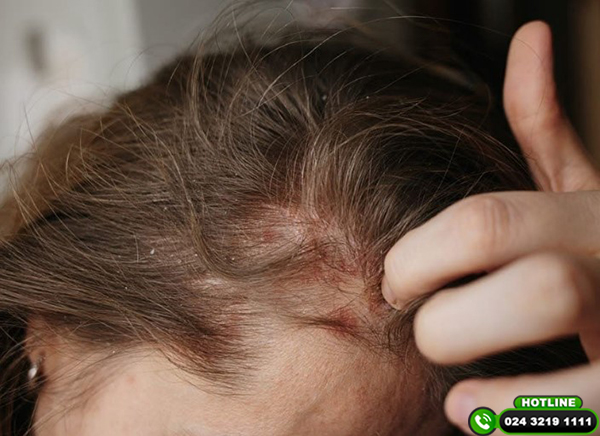 Da đầu tiết quá nhiều dầu: Nguyên nhân và cách khắc phục