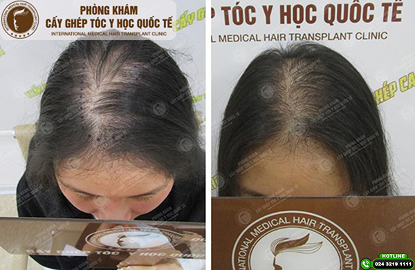 cấy tóc tư thân