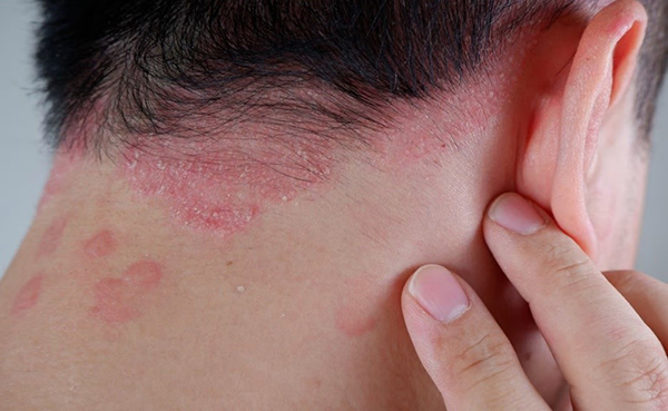 Nguyên nhân ngứa da đầu rụng tóc