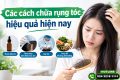 Các cách chữa rụng tóc hiệu quả hiện nay