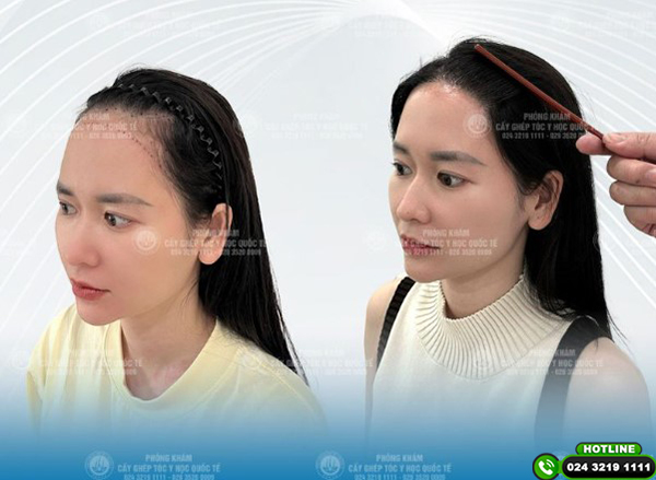cấy tóc tự thân