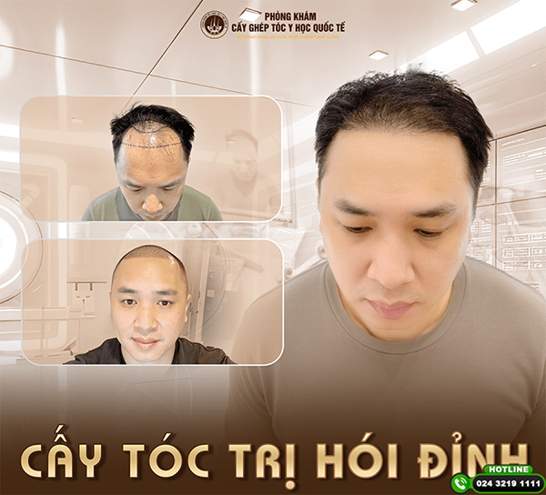 khắc phục rụng tóc nam