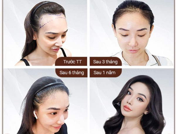 cấy tóc tự thân