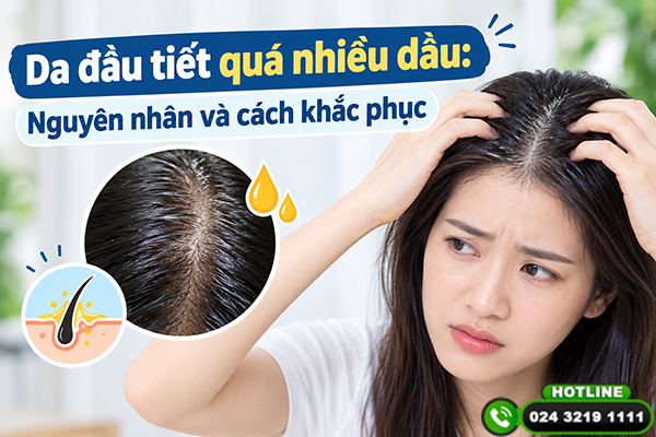 Da đầu tiết quá nhiều dầu: Nguyên nhân và cách khắc phục