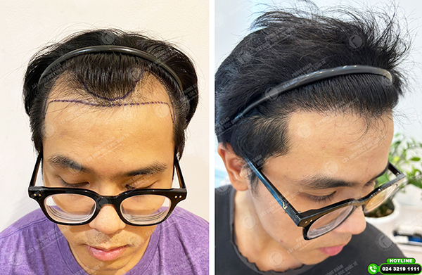 cấy tóc tự thân