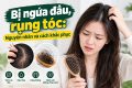 ngứa da đầu rụng tóc Nguyên nhân và cách khắc phục