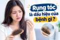 rụng tóc dấu hiệu của bệnh gi