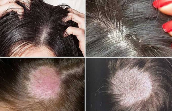 rụng tóc dấu hiệu của bệnh lý da đầu