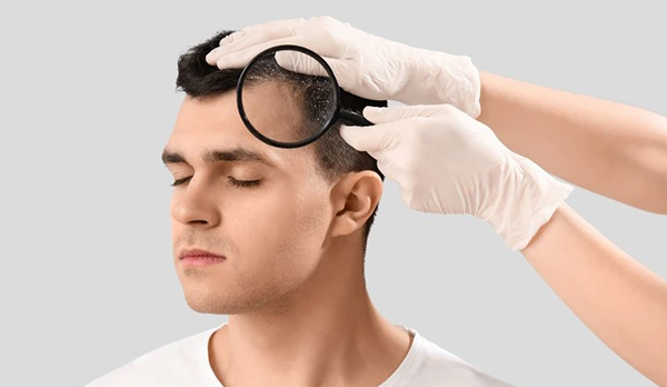 rụng tóc tuổi 20 có đáng lo ngại