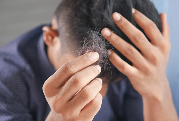 rụng tóc ở nam giới